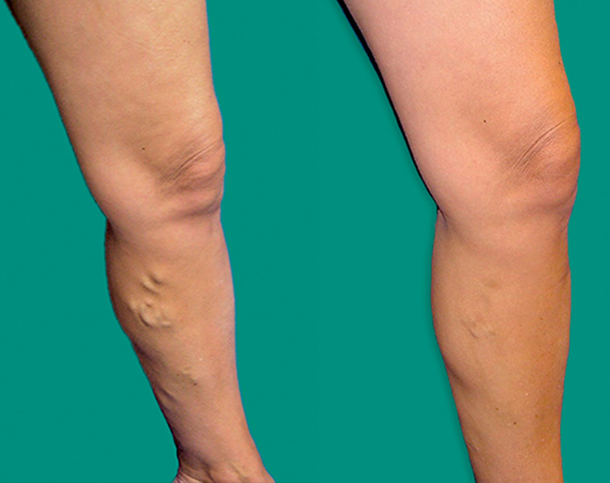 Before and after vein treatment, Miami Vein Institute case 1