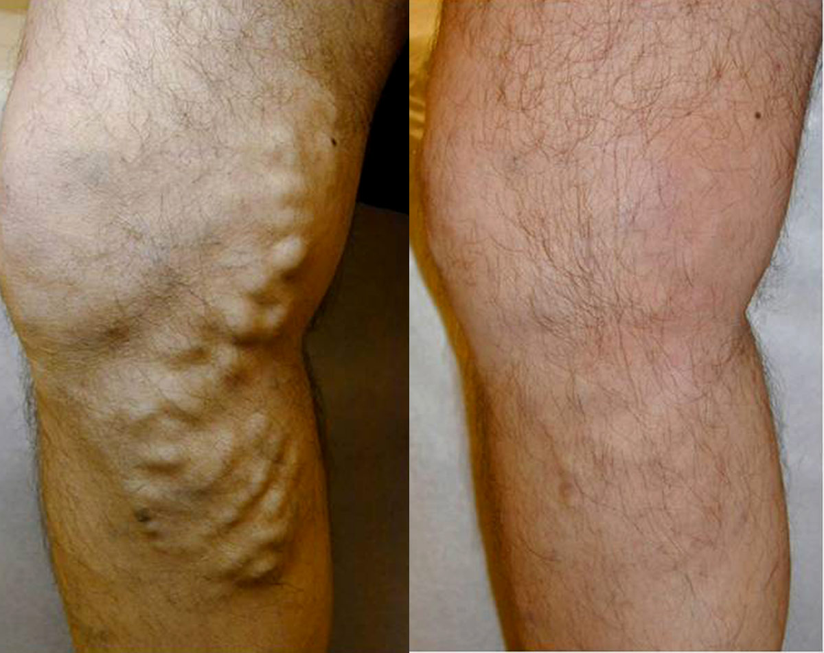 Before and after vein treatment, Miami Vein Institute case 2