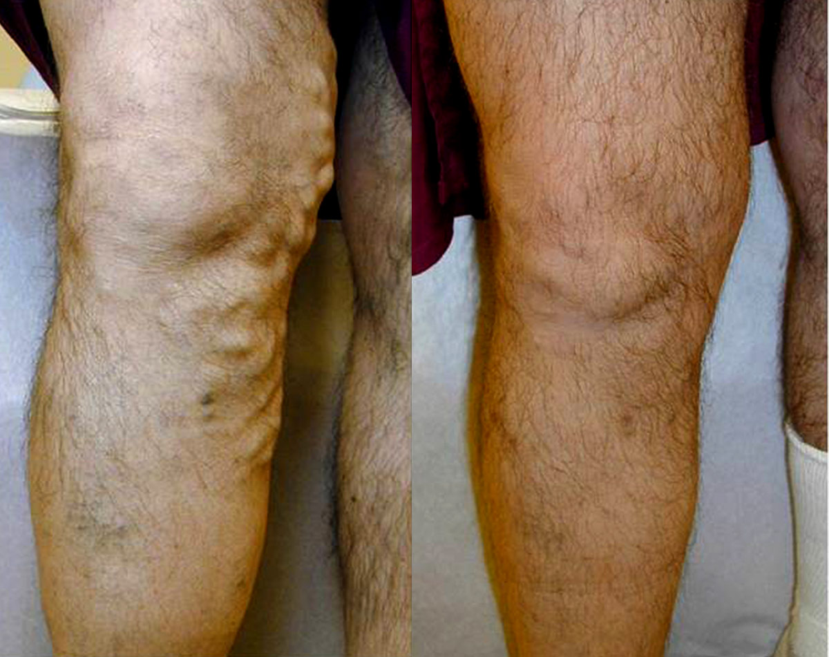 Before and after vein treatment, Miami Vein Institute case 3