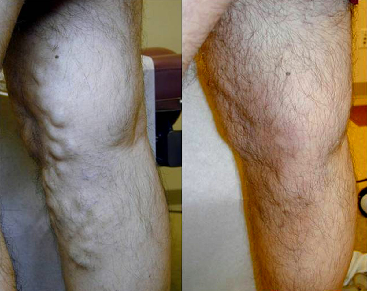 Before and after vein treatment, Miami Vein Institute case 4