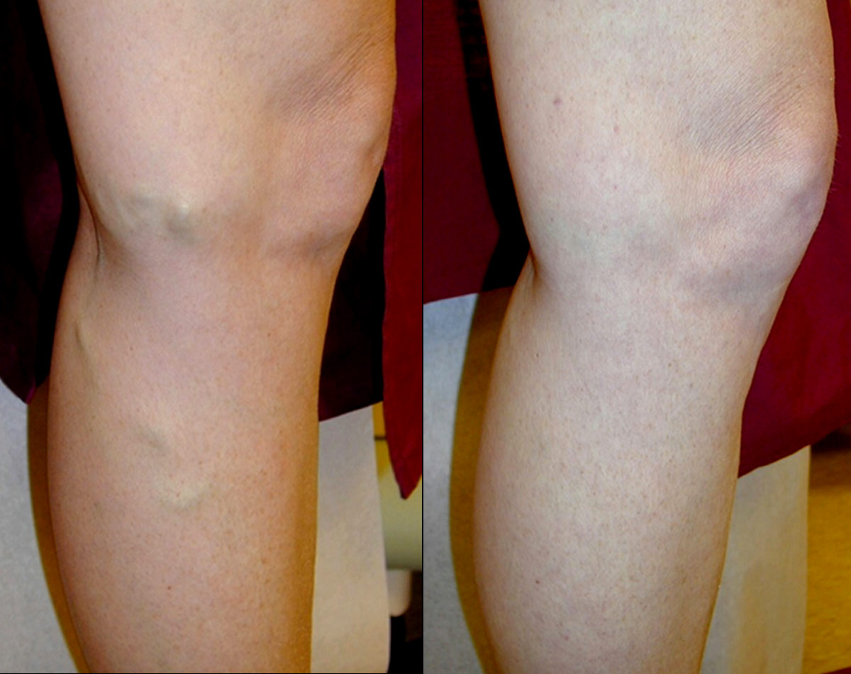 Before and after vein treatment, Miami Vein Institute case 5