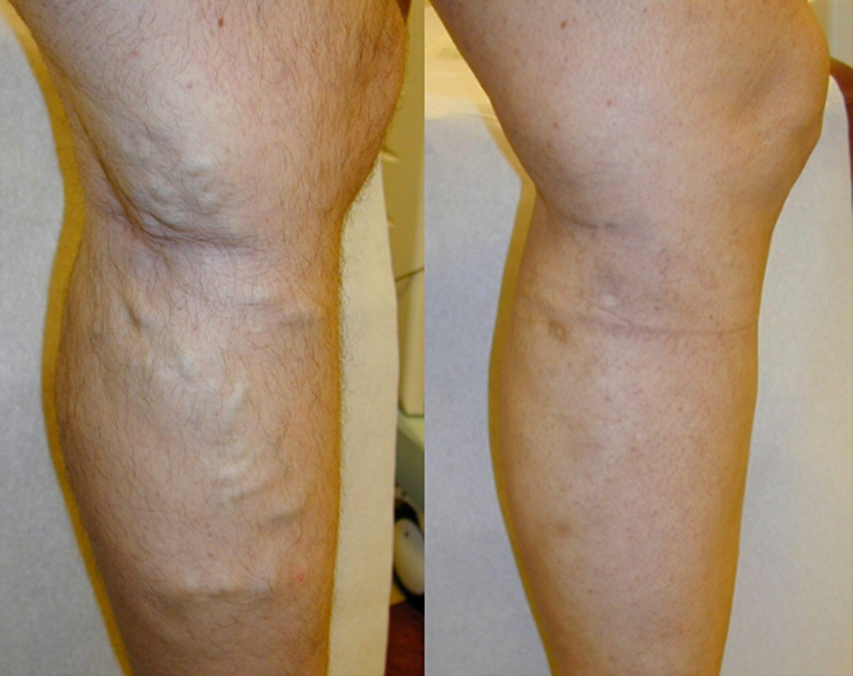 Before and after vein treatment, Miami Vein Institute case 7