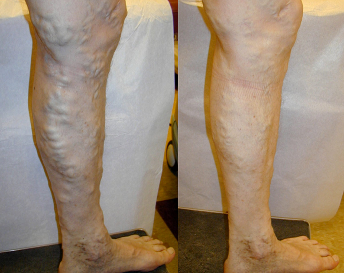 Before and after vein treatment, Miami Vein Institute case 8