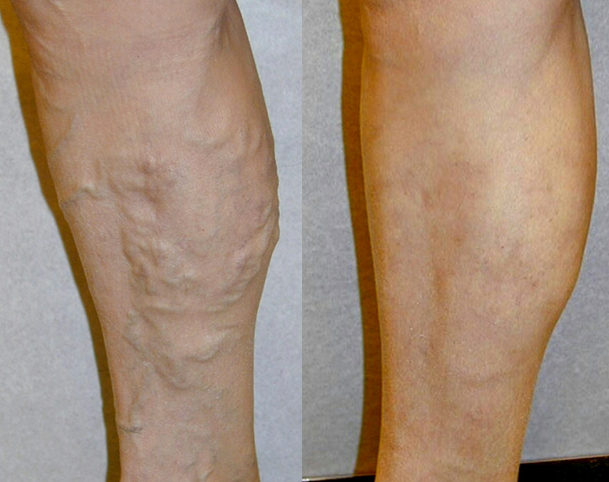 Before and after vein treatment, Miami Vein Institute case 14