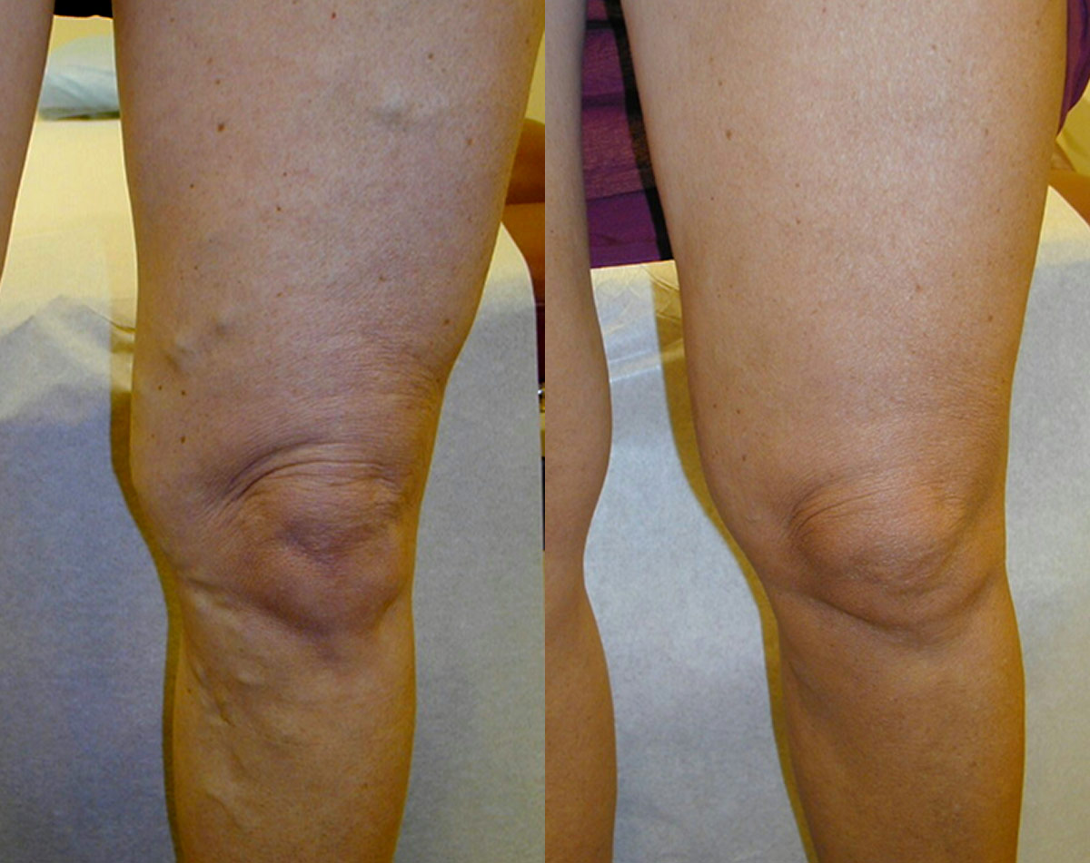 Before and after vein treatment, Miami Vein Institute case 15