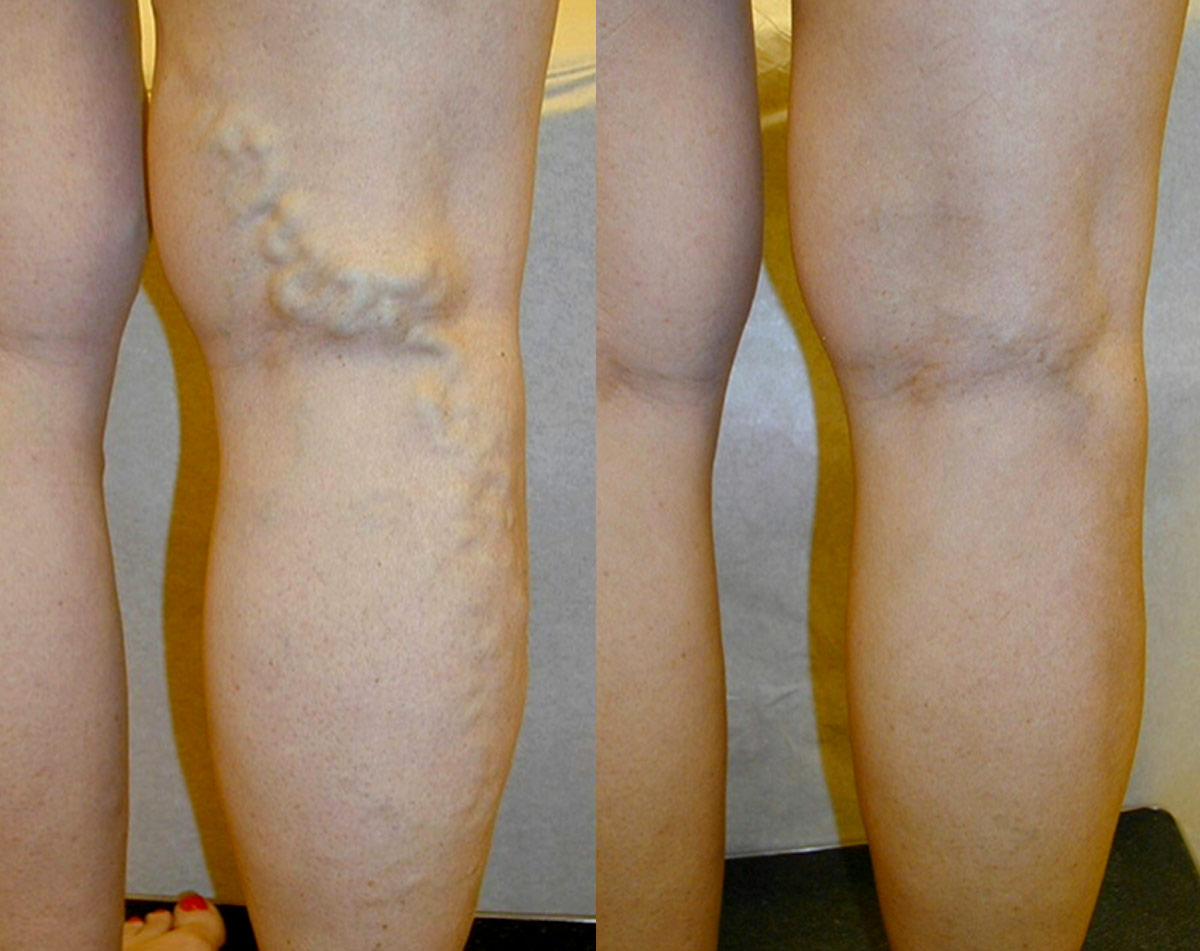 Before and after vein treatment, Miami Vein Institute case 16