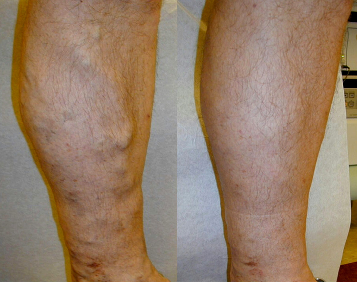 Before and after vein treatment, Miami Vein Institute case 17