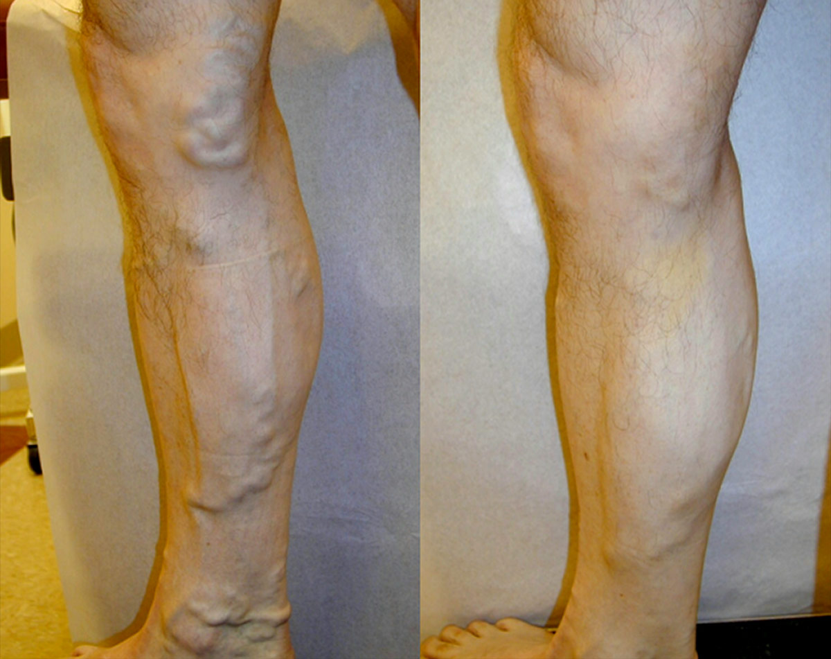 Before and after vein treatment, Miami Vein Institute case 18