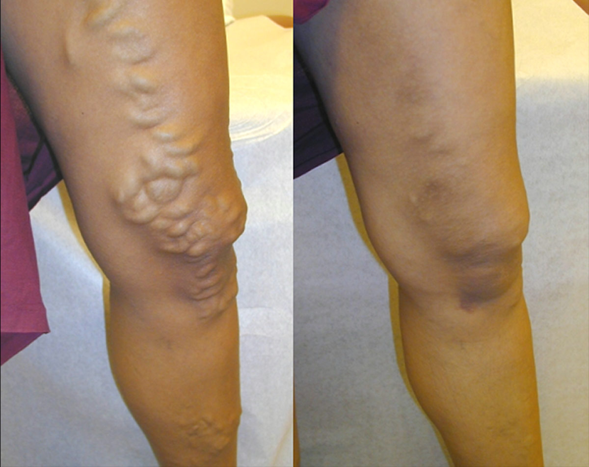 Before and after vein treatment, Miami Vein Institute case 20