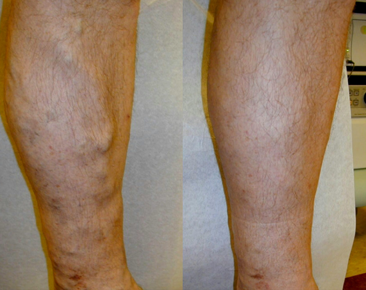 Before and after vein treatment, Miami Vein Institute case 21
